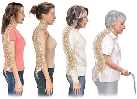 illustration by lightbox visuals of kyphosis a type of curvature of the spine also know as