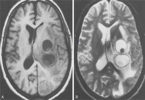 Abnormal Mri Brain Tuberculoma Radiology Imaging