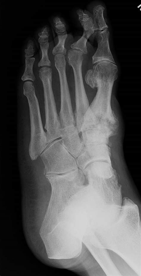 Charcot Neuroarthropathy | The Foot and Ankle Online Journal