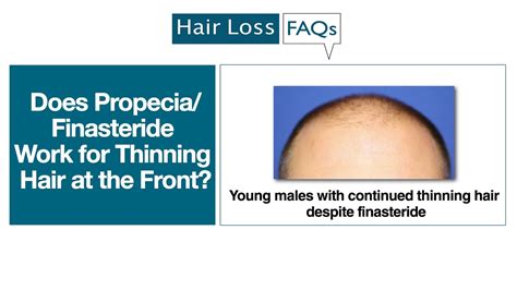 Dhananjay chavan gives a brief idea about how to use minoxidil fo. Does Propecia/Finasteride Work for Thinning Hair at the ...