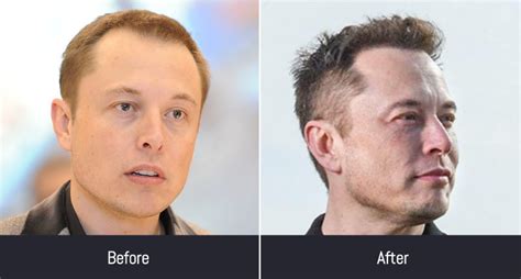 Celebrity Hair Transplants And Their Before And After Photos