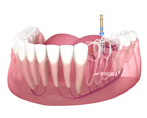 Root Canals San Marcos Aquasprings Dental Dentist Tx 78666