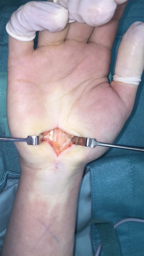 Carpaltunnelsyndrom, cts, medianuskompressionssyndrom, brachialgia paraesthetica nocturna) ist ein begriff aus der medizin und bezeichnet ein kompressionssyndrom des nervus medianus im bereich der. Karpaltunnelsyndrom