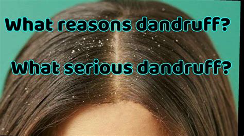What Causes Dandruff And Why Happens And How To Treat Dandruff Youtube