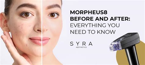 Morpheus8 Before And After Everything You Need To Know Sa