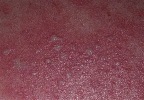 Young Woman With Diffuse Pustular Rash Annals Of Emergency Medicine