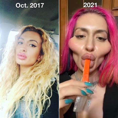 People In The Botched Surgeries Reddit Share Pictures Of Their