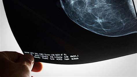 Mammograms May Lead To Breast Cancer Overdiagnosis For Some Women