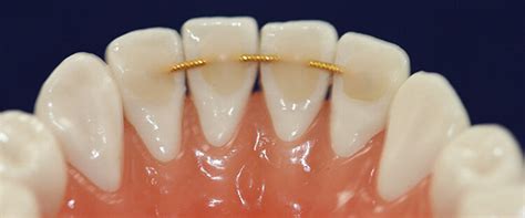 The Best Orthodontic Retainer For Your Top Teeth Jorgensen