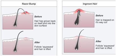 Ingrown Hair Causes Symptoms Diagnosis And Treatment Natural Health