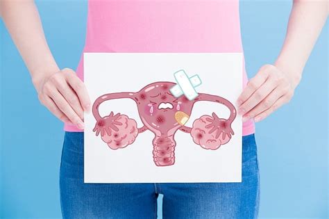 Endometrioza Przyczyny Objawy Leczenie Choroby Od A Do Z