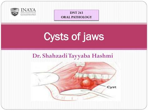 Ppt Cysts Of Jaws Powerpoint Presentation Id5296491