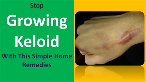 Stop Growing Keloid With This Simple Home Remedies Youtube