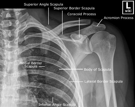 Scapula Radiographic Anatomy WikiRadiography