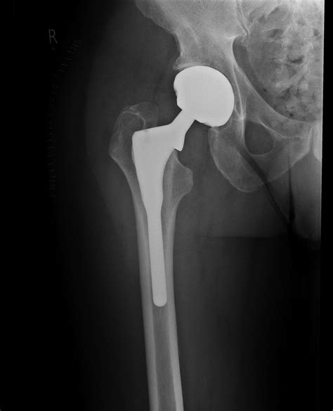 Total Hip Arthroplasty Infection Caused By An Unusual Organism