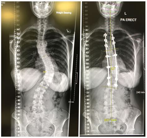 Before And After My Scoliosis Spinal Fusion [oc] R Xrayporn