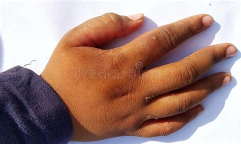 Eczema On Skineczema Peeling Macro On Male Grip Skin Stock Photo