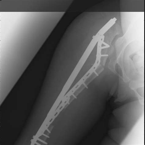 A Radiography After The Two Osteotomies Of The Femur The Distal