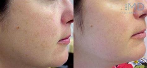 Silkpeel Dermalinfusion For Sun Damage Facial Treatment Facial Age