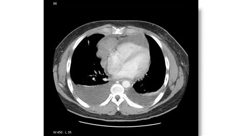 Primary Mediastinal Large B Cell Lymphoma Ct Scan Wikidoc
