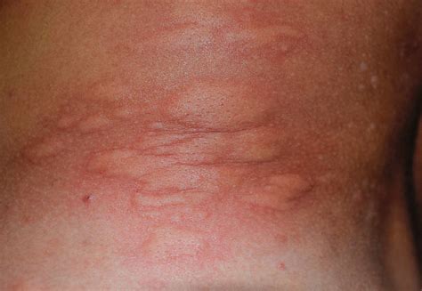 Bug Bite Insect Human Skin Allergy Stock Photos Pictures And Royalty