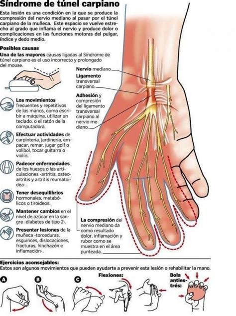 Síndrome De Túnel Carpiano Invdes