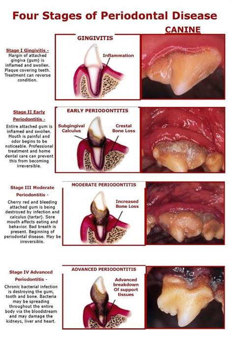 The bacteria are located on the teeth and the tissues surrounding the teeth (periodontium). Dental Health