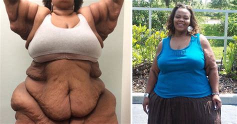 Worlds Fattest Woman Sheds 36 Stone After Being Bulldozed From House