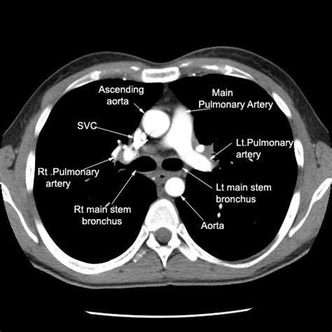 Ct Scan Tips And Protocols Ct Pulmonery Vessels Anatomy