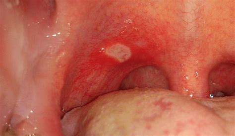 White Spots On The Throat With Pictures