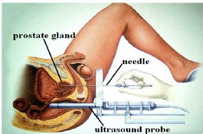 Prostate Brachytherapy Implant Technique Source Download Scientific Diagram