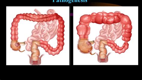 Symptoms of intestinal (bowel) obstruction. intestinal obstruction - YouTube