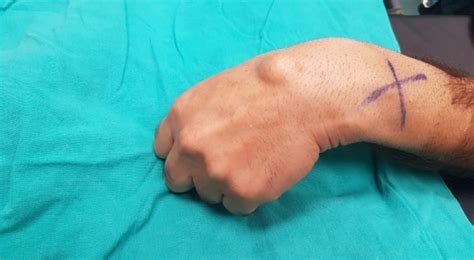 Ganglion Cyst On Wrist