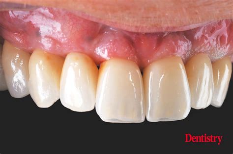 Digital workflow: a game changer for implant restoration – part two