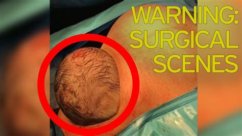 Newborns Head Pops Out Of Mums Stomach During Natural Cesarean