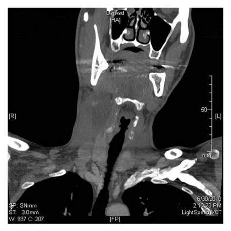 Axial Ct Scan With Contrast Showing The Cystic Neck Mass Lateral To The