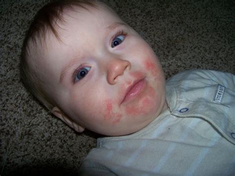 What To Do When You Notice A Rash On Babys Face Babycenter