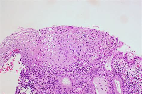 Cin 1 Low Grade Squamous Intraepithelial Lesion Squamocolumnar