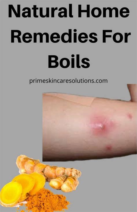 Natural Home Remedies For Boils Home Remedy For Boils Natural Home