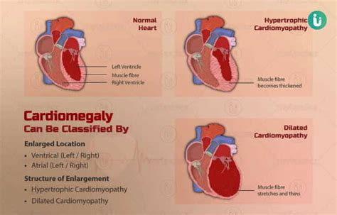 Enlarged Heart Symptoms Causes Treatment Medicine Prevention Diagnosis