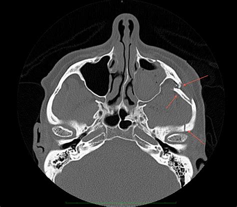 Golf Related Injury: Zygoma Fracture