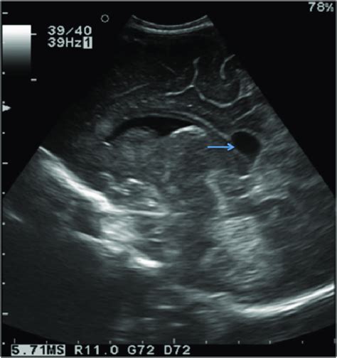 Cranial Ultrasound Scan Showing A Round Hypoechoic Formation Adjacent