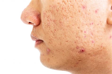 9 Best Treatments That To Close Open Pores On Face Vitalsklinic