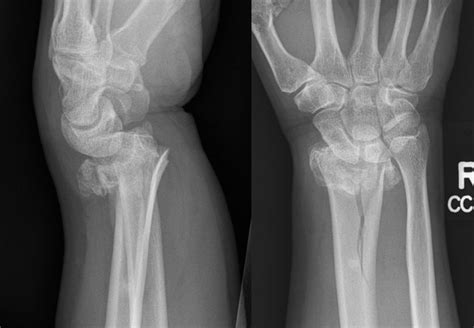 Distal Radius Fractures Simcoe Muskoka Orthopaedics