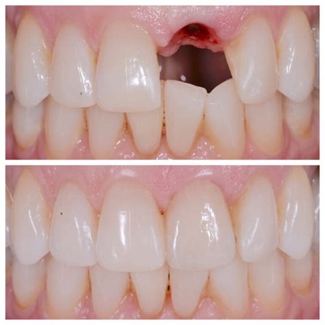 Front Tooth Implant Afam Dental