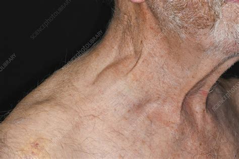 Lump Above Mans Clavicle Due To Lymphoma Stock Image C0585523