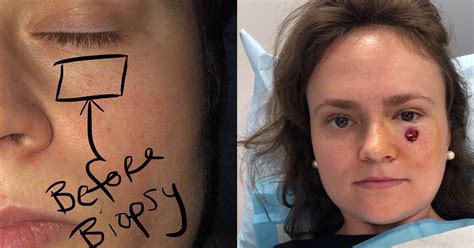 Sunburn and skin cancer facts: Kvinne (24) fikk det hun trodde var en liten kvise under ...