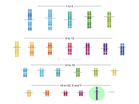 A Karyotype Of Turner Syndrome Explained KaryotypingHub