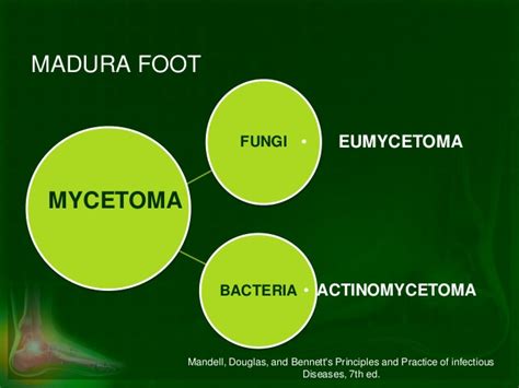 The infection can be caused by true fungi (eumycetoma) in 40%, or filamentous bacteria. Madura Foot