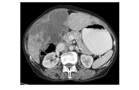 Large Polypoidal Fungating Gallbladder Mass With Gross Invasion Of